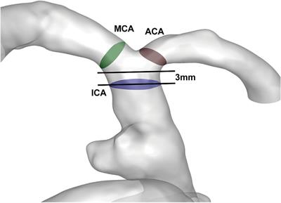 Classification and hemodynamic characteristics of delayed intracerebral hemorrhage following stent-assisted coil embolism in unruptured intracranial aneurysms